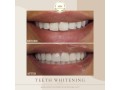 trusted-dental-clinic-in-dubai-small-8